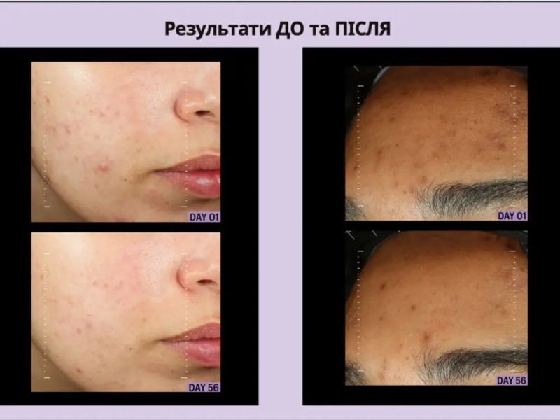 Allies Of Skin Azelaic & Kojic Advanced Clarifying Serum Сироватка освітлююча з азелаїновою кислотою ALS7 фото