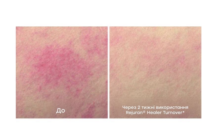 REJURAN TURNOVER AMPOULE Сироватка для інтенсивного відновлення шкіри RJR18 фото